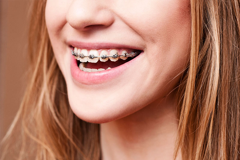 Orthodontics in Meridian