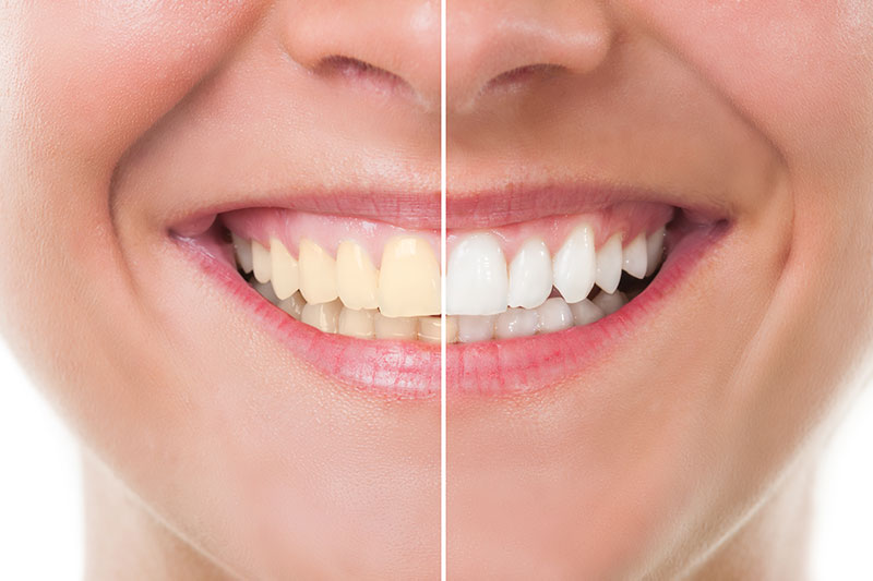 Teeth Whitening in Meridian